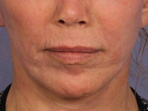 Laser Skin Resurfacing Gallery Before & After Image