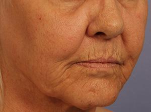 Laser Skin Resurfacing Gallery Before & After Image