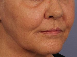 Laser Skin Resurfacing Gallery Before & After Image