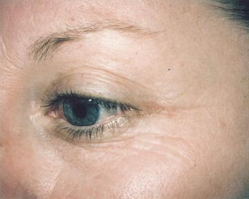 Laser Skin Resurfacing Gallery Before & After Image