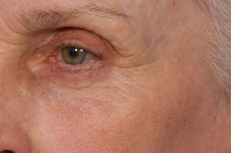 Laser Skin Resurfacing Gallery Before & After Image