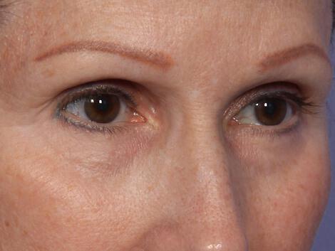 Laser Skin Resurfacing Gallery Before & After Image