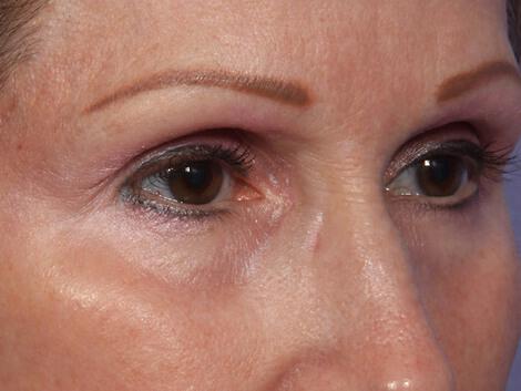 Laser Skin Resurfacing Gallery Before & After Image