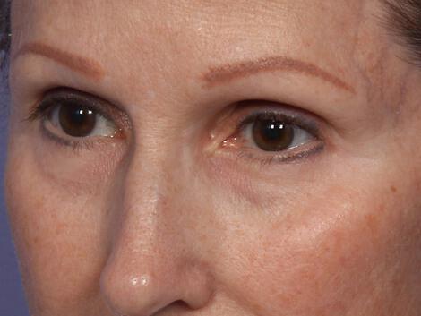 Laser Skin Resurfacing Gallery Before & After Image