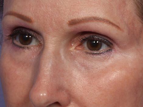 Laser Skin Resurfacing Gallery Before & After Image