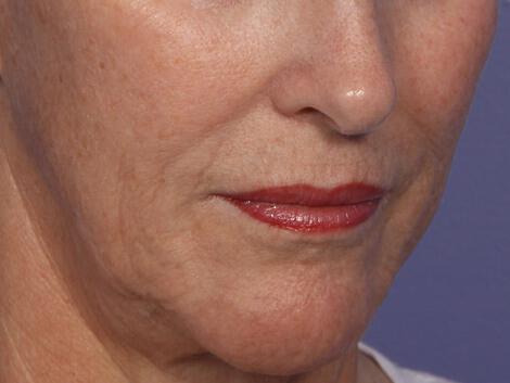 Laser Skin Resurfacing Gallery Before & After Image