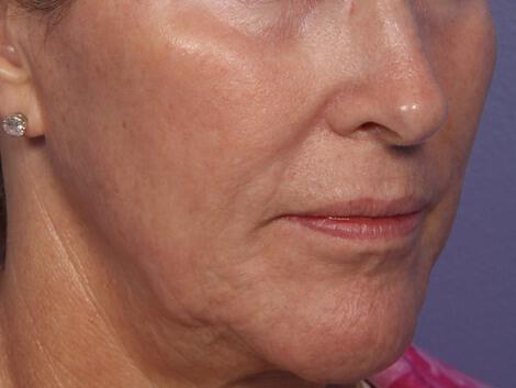 Laser Skin Resurfacing Gallery Before & After Image