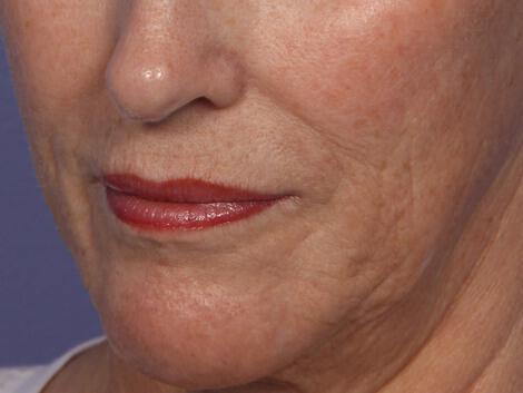 Laser Skin Resurfacing Gallery Before & After Image