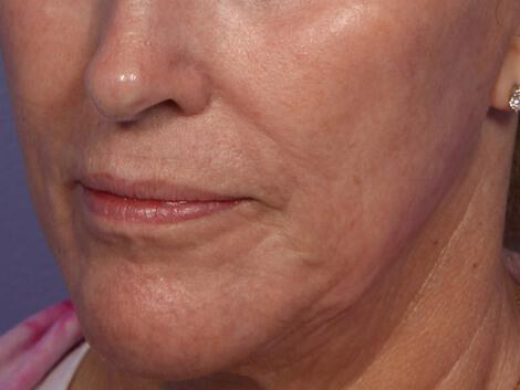 Laser Skin Resurfacing Gallery Before & After Image