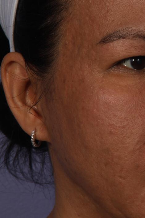 Laser Skin Resurfacing Gallery Before & After Image