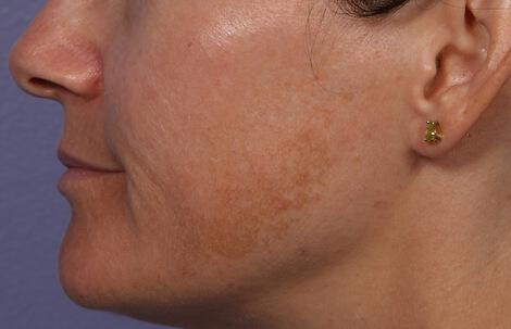 Laser Skin Resurfacing Gallery Before & After Image