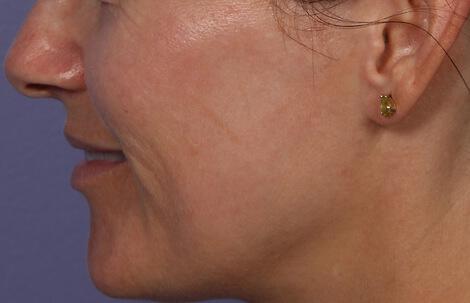 Laser Skin Resurfacing Gallery Before & After Image