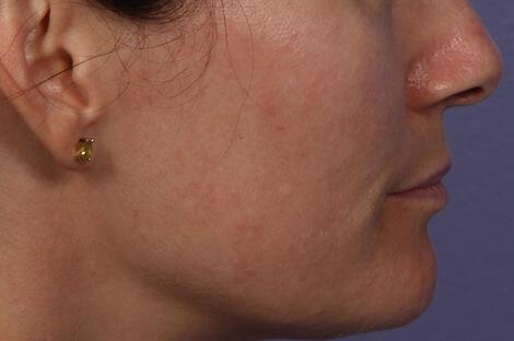 Laser Skin Resurfacing Gallery Before & After Image