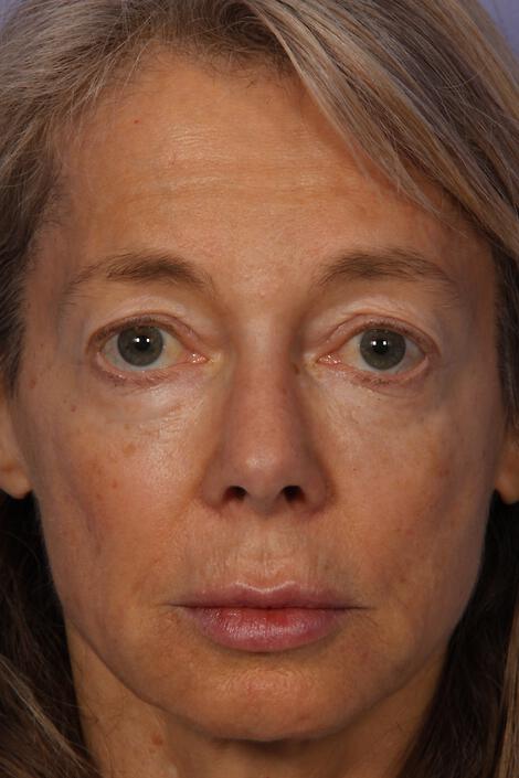 Laser Skin Resurfacing Gallery Before & After Image