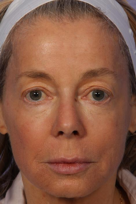 Laser Skin Resurfacing Gallery Before & After Image