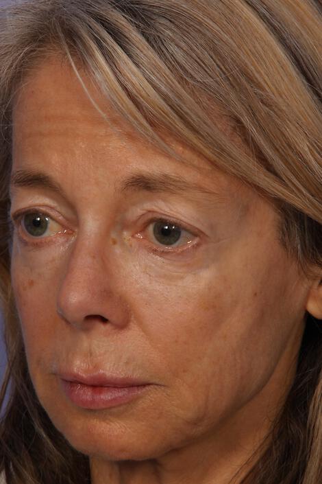 Laser Skin Resurfacing Gallery Before & After Image