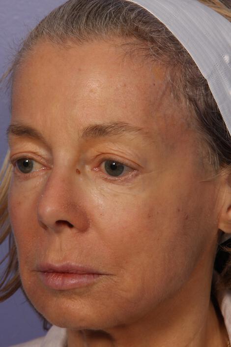 Laser Skin Resurfacing Gallery Before & After Image