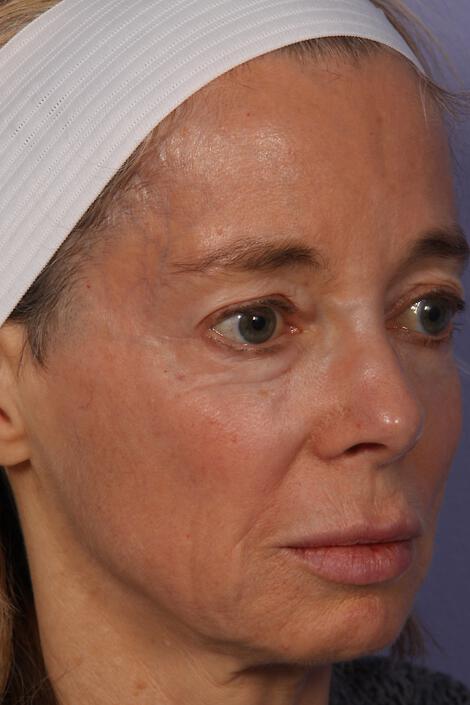 Laser Skin Resurfacing Gallery Before & After Image