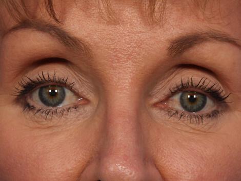 Laser Skin Resurfacing Gallery Before & After Image