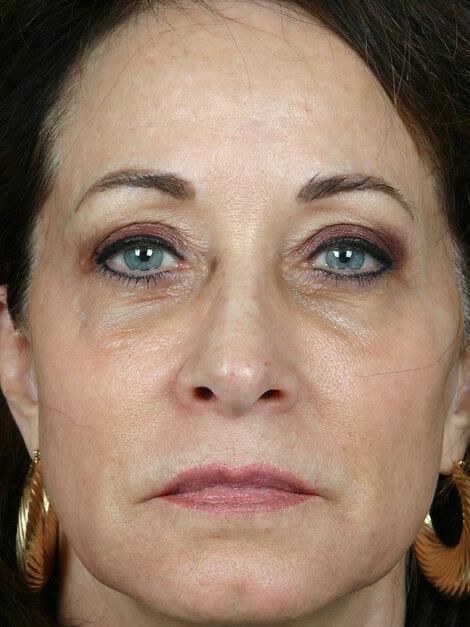 Laser Skin Resurfacing Gallery Before & After Image