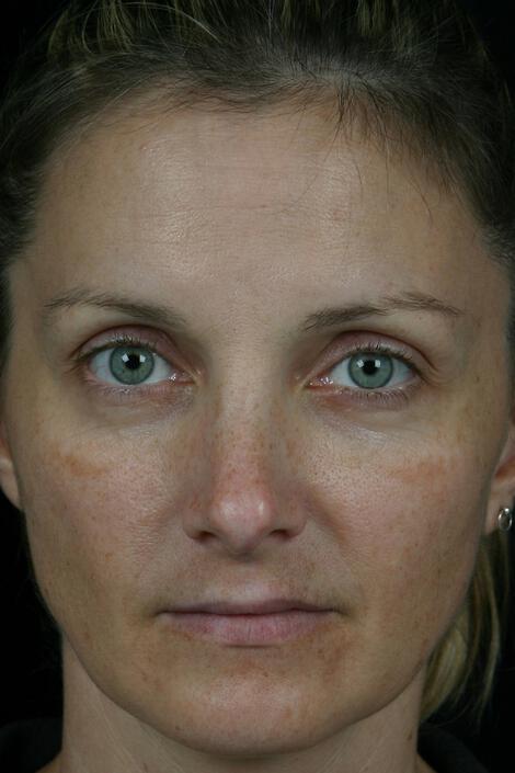 Laser Skin Resurfacing Gallery Before & After Image