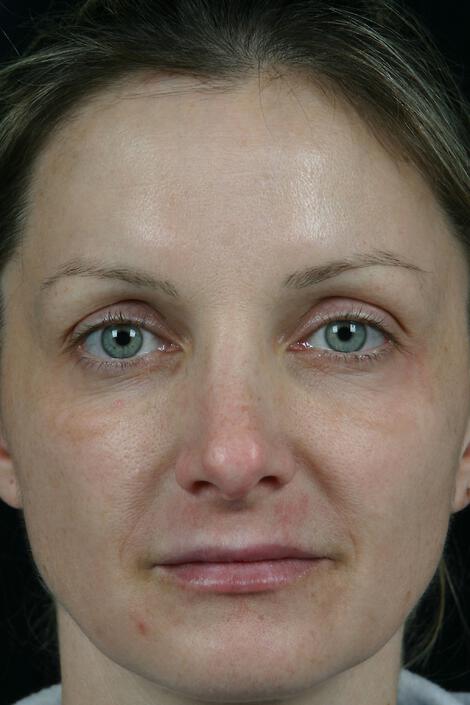 Laser Skin Resurfacing Gallery Before & After Image