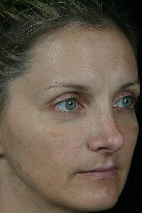 Laser Skin Resurfacing Gallery Before & After Image