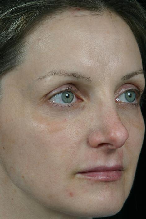 Laser Skin Resurfacing Gallery Before & After Image