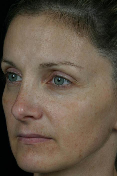 Laser Skin Resurfacing Gallery Before & After Image