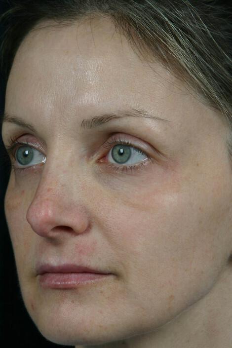 Laser Skin Resurfacing Gallery Before & After Image