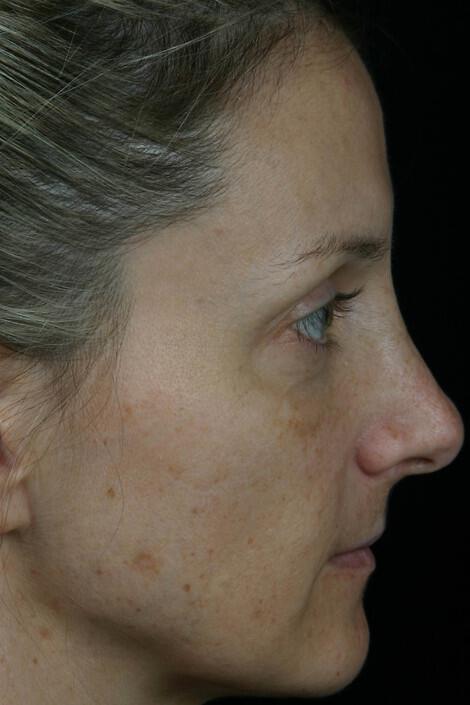 Laser Skin Resurfacing Gallery Before & After Image