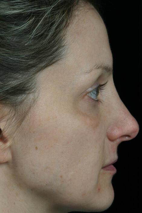 Laser Skin Resurfacing Gallery Before & After Image