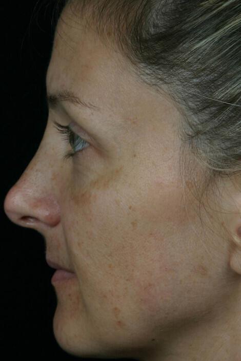 Laser Skin Resurfacing Gallery Before & After Image