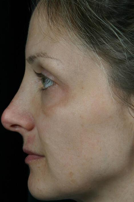 Laser Skin Resurfacing Gallery Before & After Image