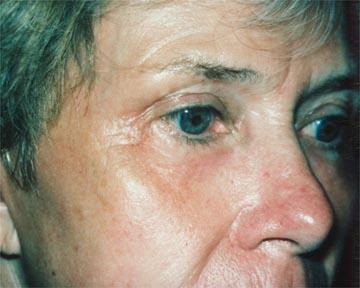 Laser Skin Resurfacing Gallery Before & After Image