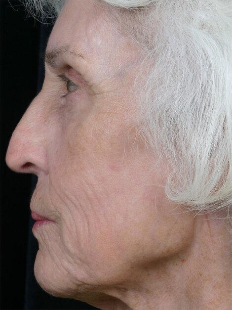 Laser Skin Resurfacing Gallery Before & After Image