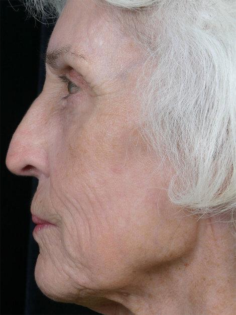 Laser Skin Resurfacing Gallery Before & After Image