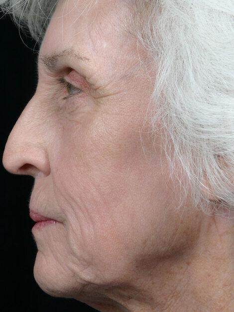 Laser Skin Resurfacing Gallery Before & After Image