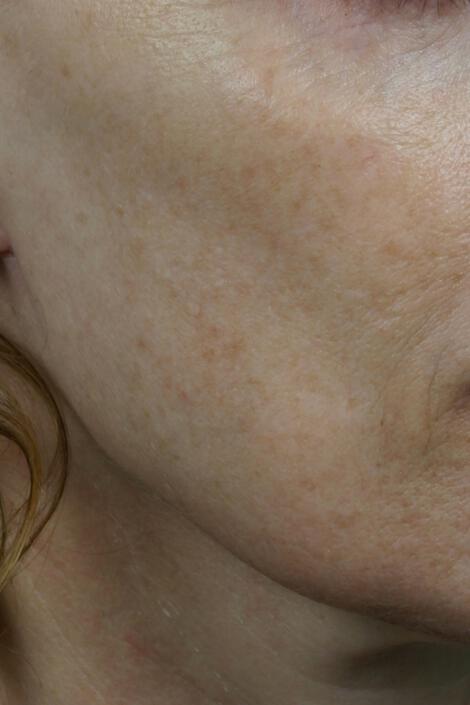 Laser Skin Resurfacing Gallery Before & After Image