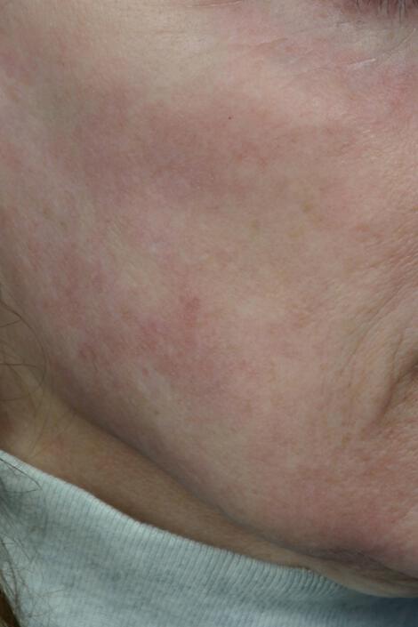 Laser Skin Resurfacing Gallery Before & After Image