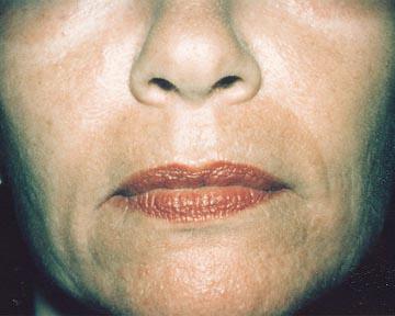 Laser Skin Resurfacing Gallery Before & After Image