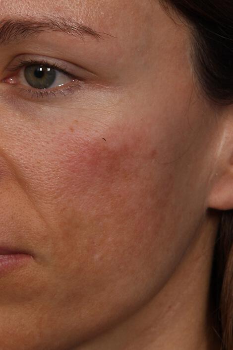 Laser Skin Resurfacing Gallery Before & After Image