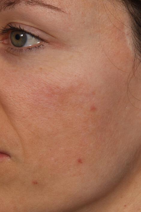 Laser Skin Resurfacing Gallery Before & After Image