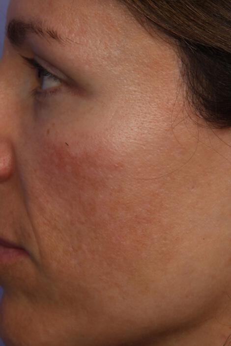 Laser Skin Resurfacing Gallery Before & After Image