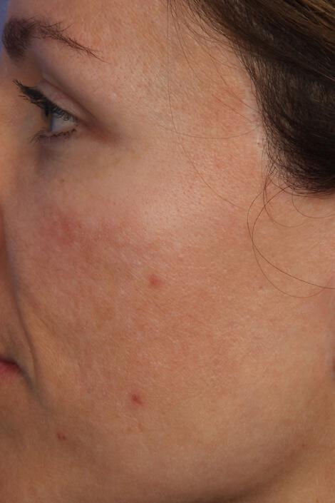 Laser Skin Resurfacing Gallery Before & After Image