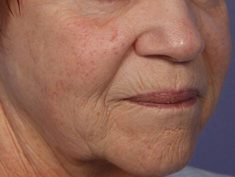 Laser Skin Resurfacing Gallery Before & After Image