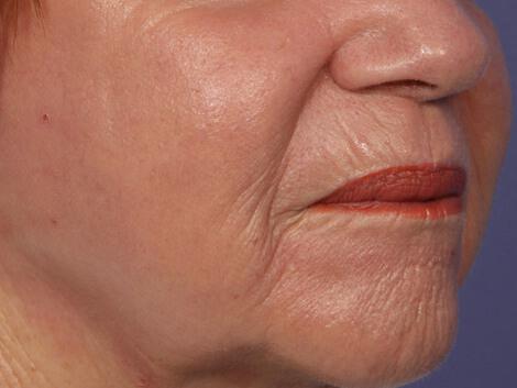 Laser Skin Resurfacing Gallery Before & After Image