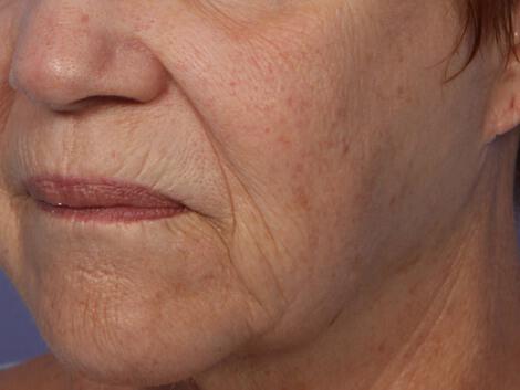 Laser Skin Resurfacing Gallery Before & After Image