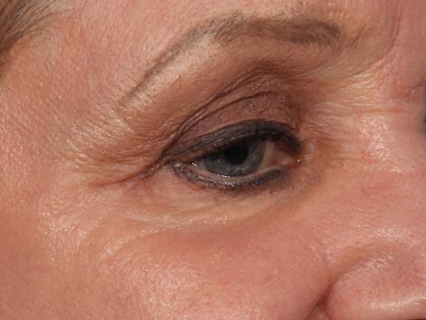 Laser Skin Resurfacing Gallery Before & After Image