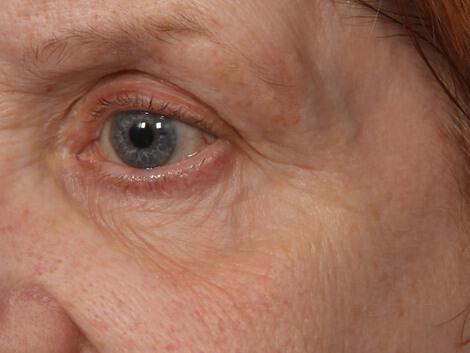 Laser Skin Resurfacing Gallery Before & After Image